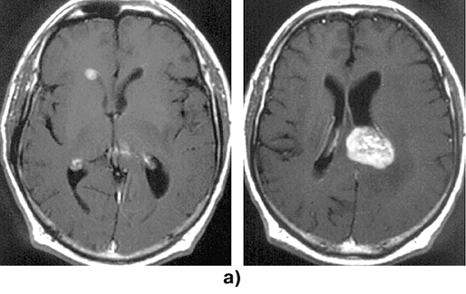 Первичные лимфомы ЦНС