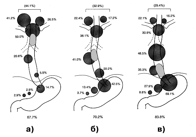 Частота метастазирования в регионарные лимфатические узлы при раке шейного